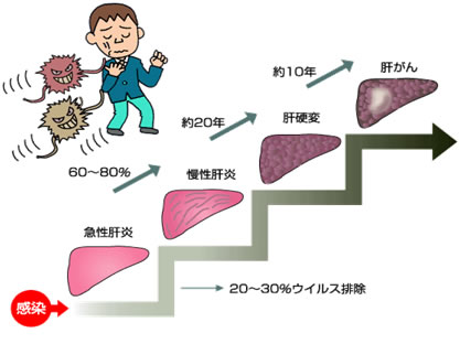 C型肝炎