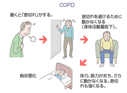COPDの代表的な症状