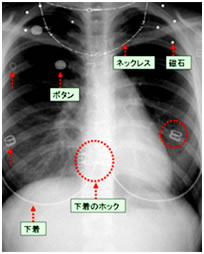 レントゲンに写る物